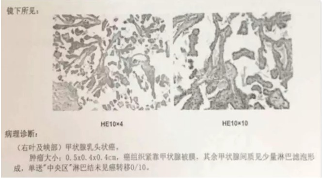 別慌，甲狀腺疾病還可以這樣投保！